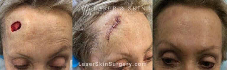 Mohs surgery to treat skin cancer on the forehead