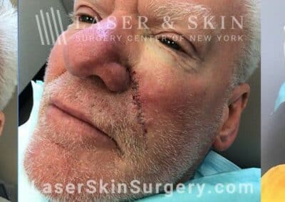 Mohs surgery to treat skin cancer on the cheek