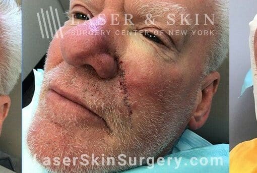 Mohs surgery to treat skin cancer on the cheek