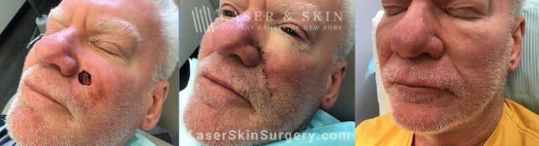 Mohs surgery to treat skin cancer on the cheek