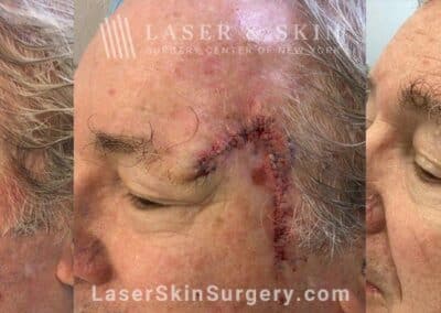 Mohs surgery to treat skin cancer on the temple