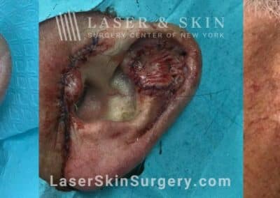 Skin graft after Mohs surgery to repair the ear