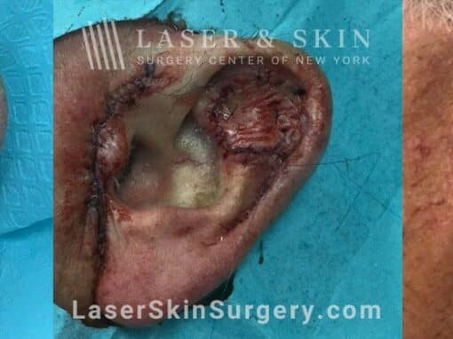 Skin graft after Mohs surgery to repair the ear