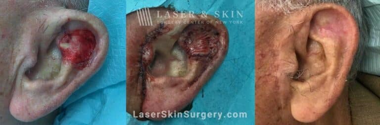 Skin graft after Mohs surgery to repair the ear