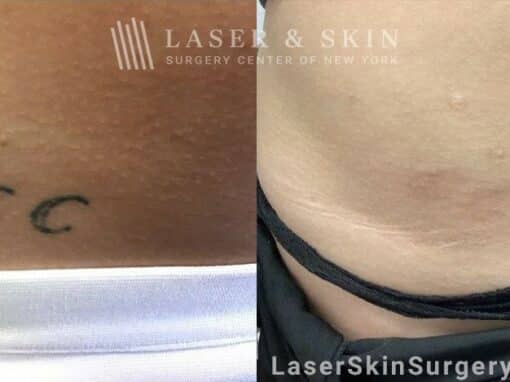 Picoplus laser to treat unwanted tattoo near the hip and abdomen