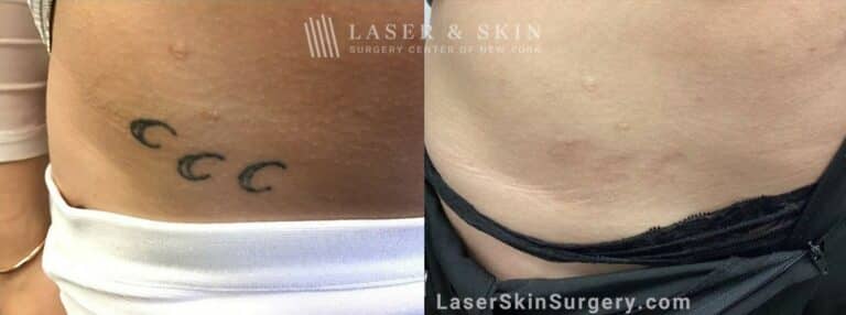 Picoplus laser to treat unwanted tattoo near the hip and abdomen