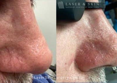 Vbeam laser to treat redness and visible blood vessels on the nose