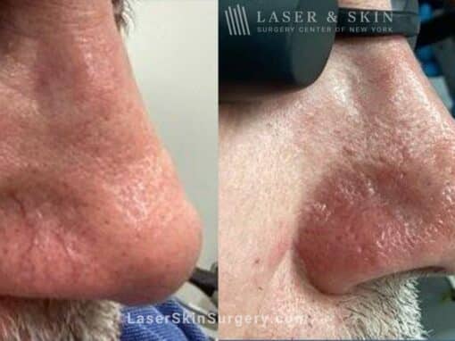 Vbeam laser to treat redness and visible blood vessels on the nose