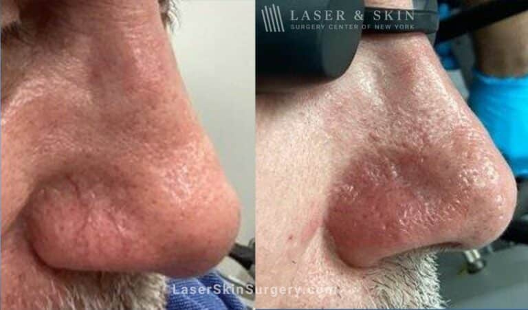 Vbeam laser to treat redness and visible blood vessels on the nose