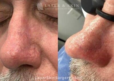 Vbeam laser to treat redness and visible blood vessels on the nose