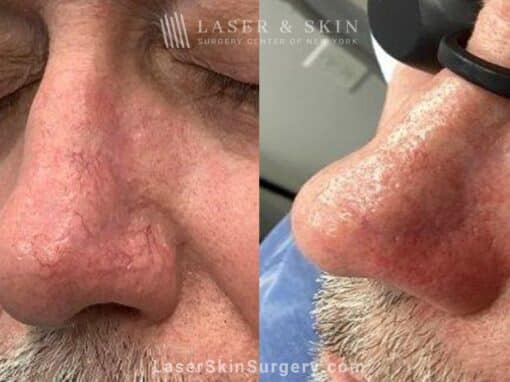 Vbeam laser to treat redness and visible blood vessels on the nose