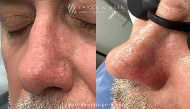 Vbeam laser to treat redness and visible blood vessels on the nose