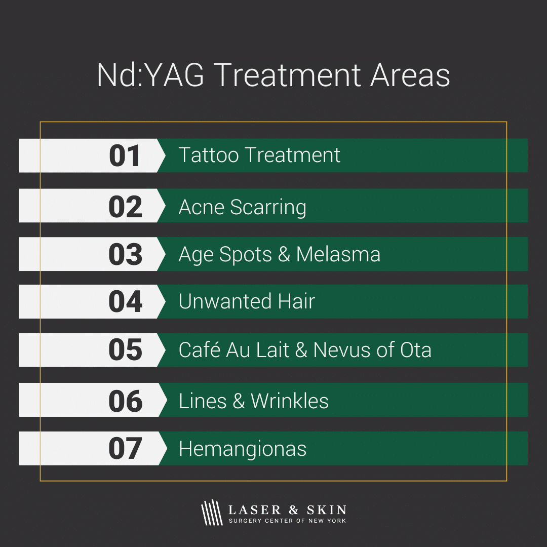 nd yag treatment areas infographic