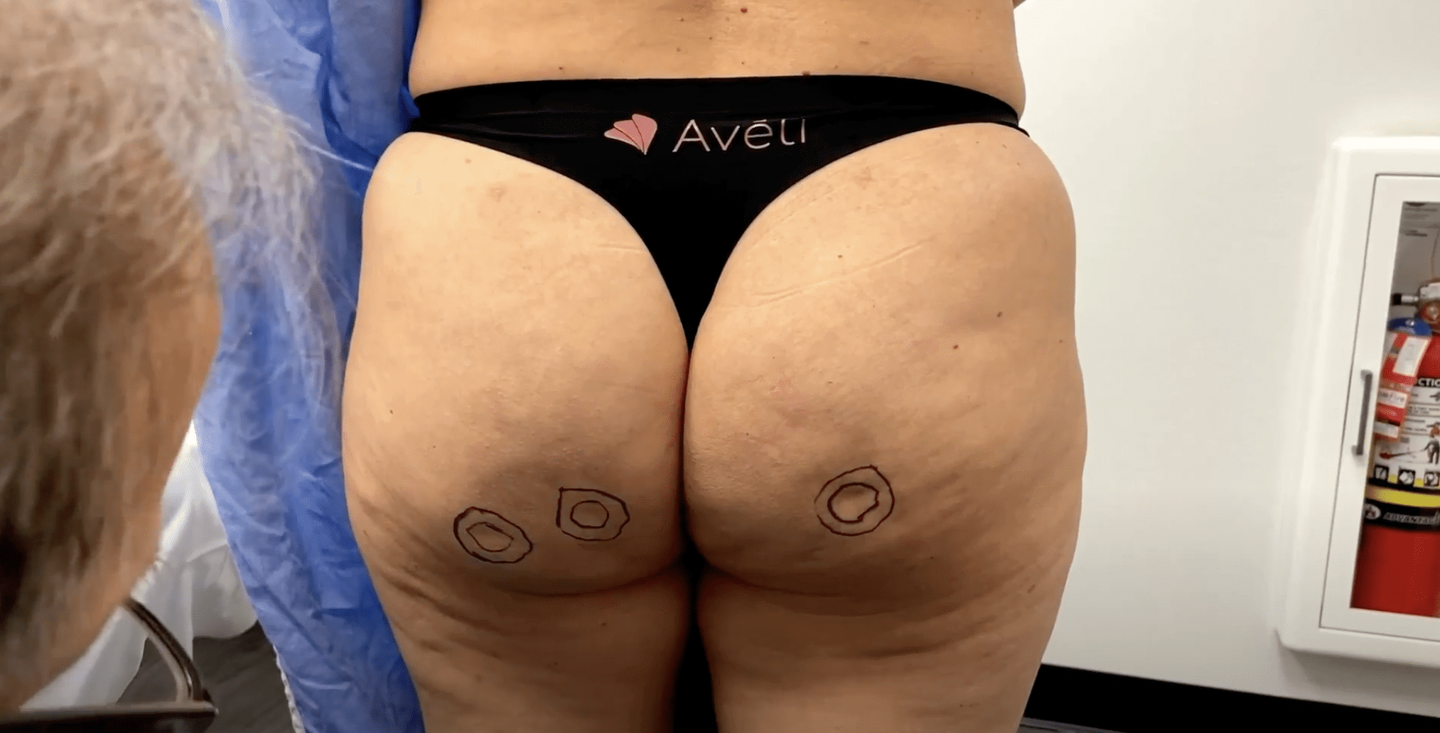 lsscny-nyc-ron-shelton-aveli-before-after-1 patient performing to undergo aveli cellulite treatment at our new york office