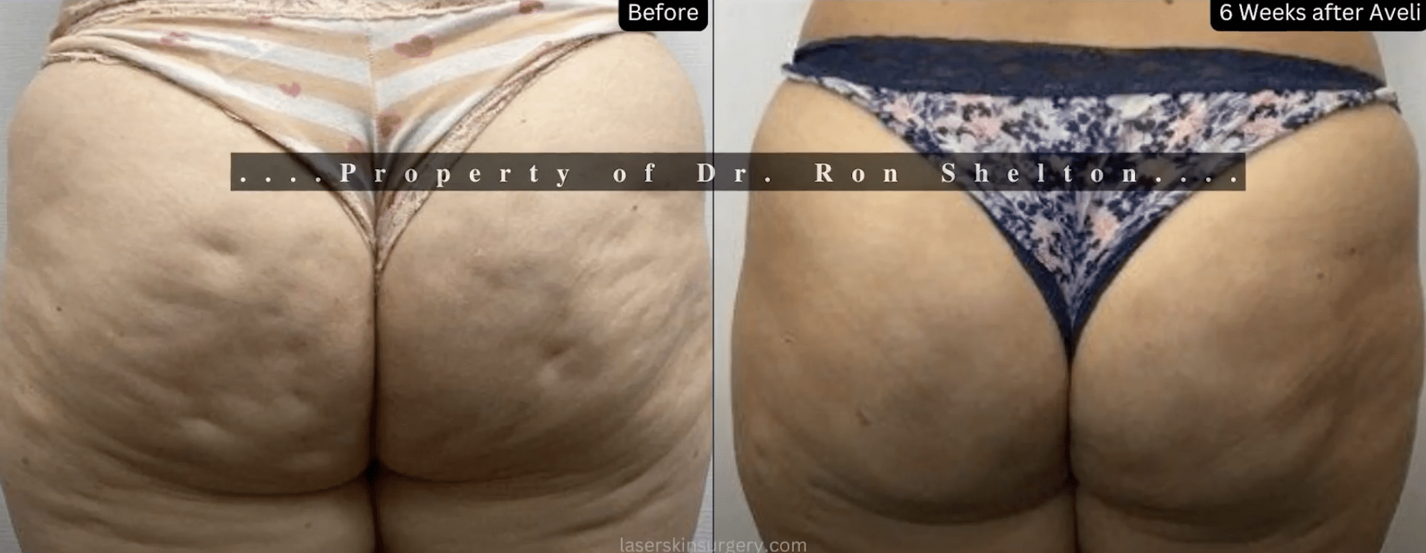 lsscny-nyc-ron-shelton-aveli-before-after dermatologists discussing Cellfina for cellulite treatment in NYC, NY