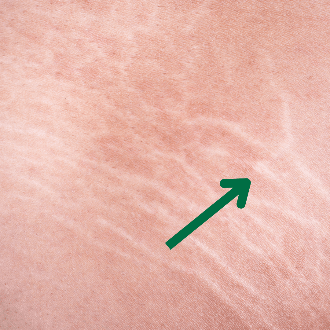 stretchmarks appearance on skin