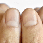 Discover What Those Nail Dents Reveal About Your Health + the Nail Symptom that Can Be the First Sign of a Slow Thyroid