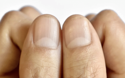 Discover What Those Nail Dents Reveal About Your Health + the Nail Symptom that Can Be the First Sign of a Slow Thyroid