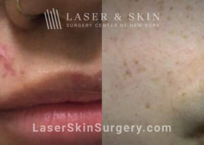 Laser Treatment for Dog Bite Scar