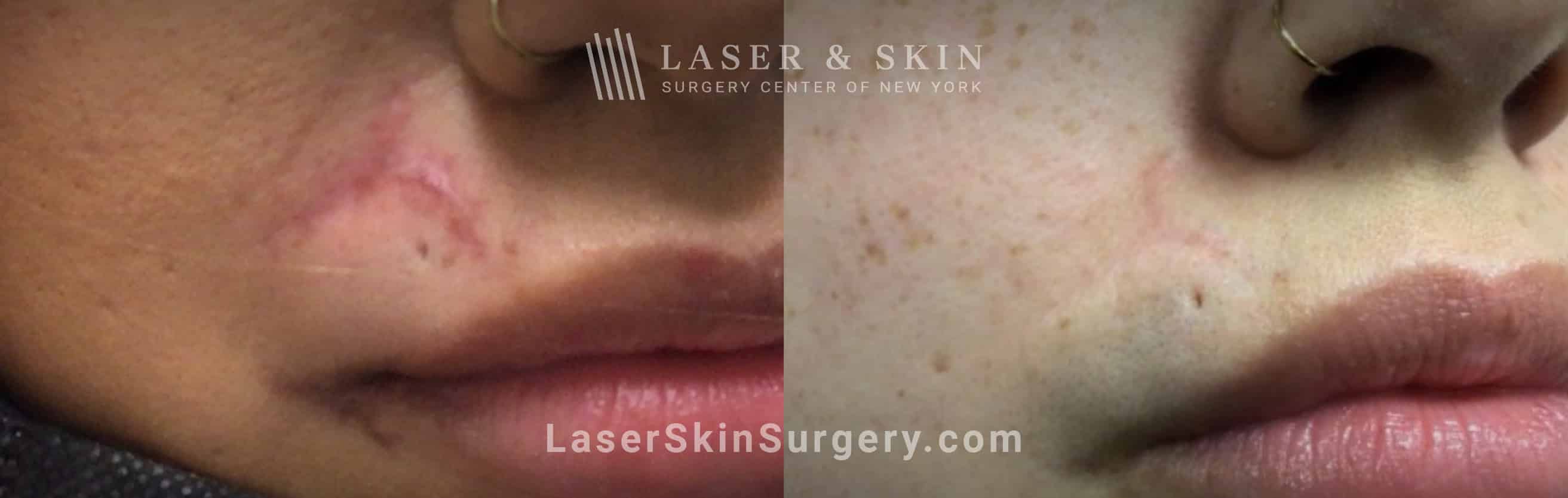 Image Dr. Leonard J. Bernstein is performing scar removal treatment in New York, NY.