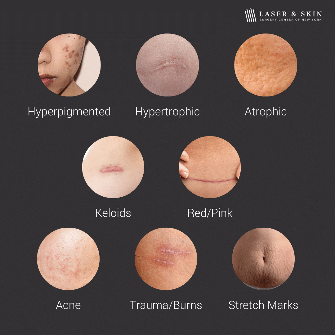 types of scars we can treat