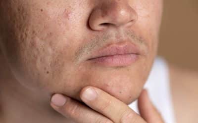 How to Treat Rolling Acne Scars