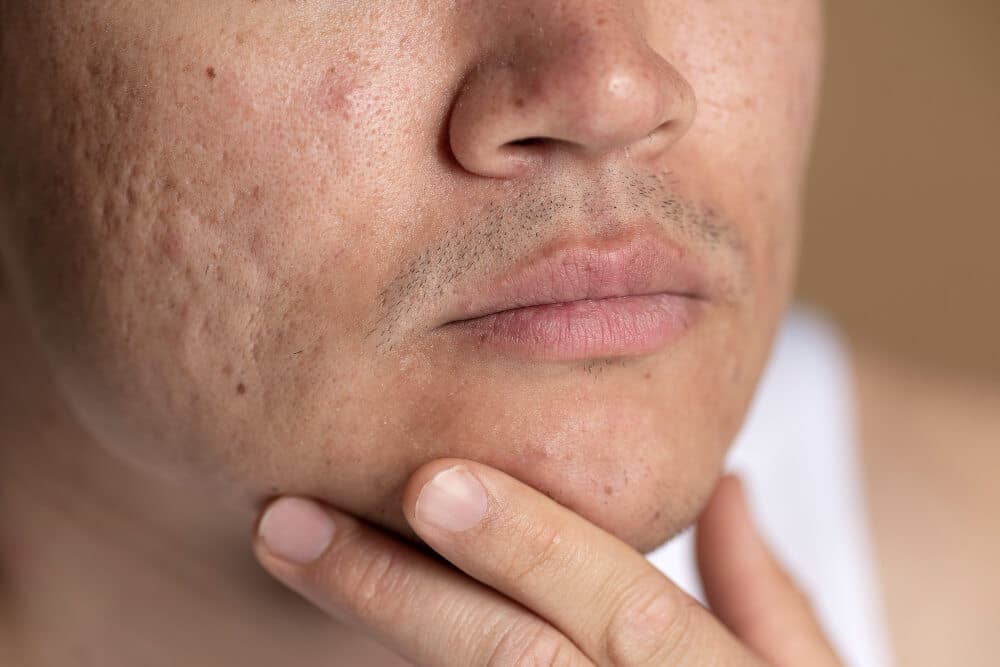 How to Treat Rolling Acne Scars
