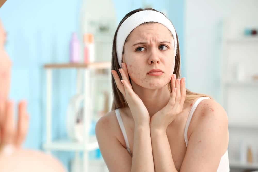 Is your acne hormonal or bacterial Expert dermatologists share