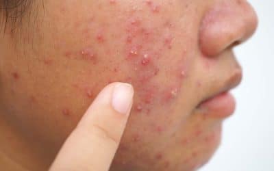 Treat Ice Pick Acne Scars: Your How-To Guide