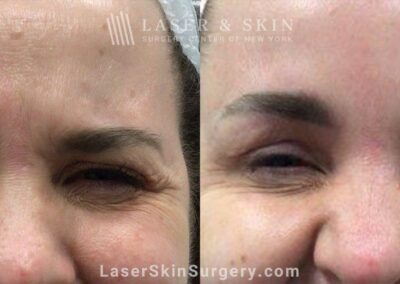 Daxxify brow lift to raise and open up the eyes two weeks after treatment