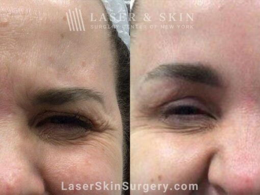 Daxxify brow lift to raise and open up the eyes two weeks after treatment