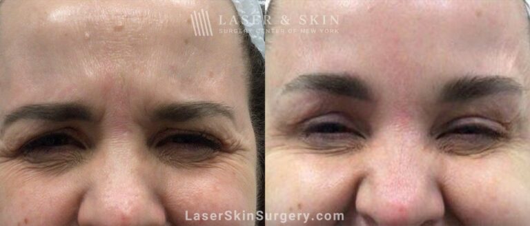 Daxxify brow lift to raise and open up the eyes two weeks after treatment