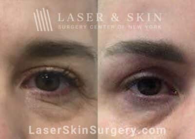 Daxxify brow lift to raise and open up the eyes two weeks after treatment