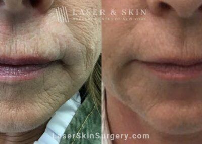 Redensity Filler for Perioral Lines Around the Mouth