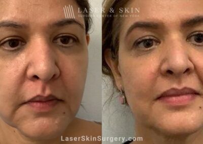 8 months post ultherapy and sofwave lifting lower face and replacing lost mid cheek volume