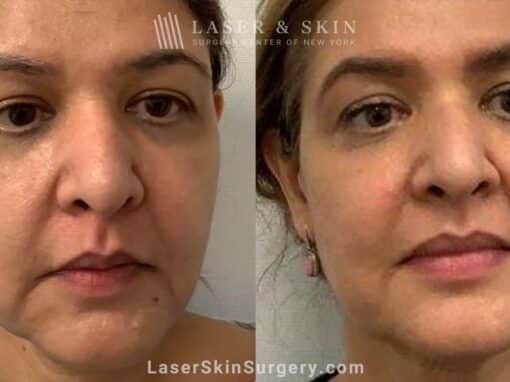 8 months post ultherapy and sofwave lifting lower face and replacing lost mid cheek volume