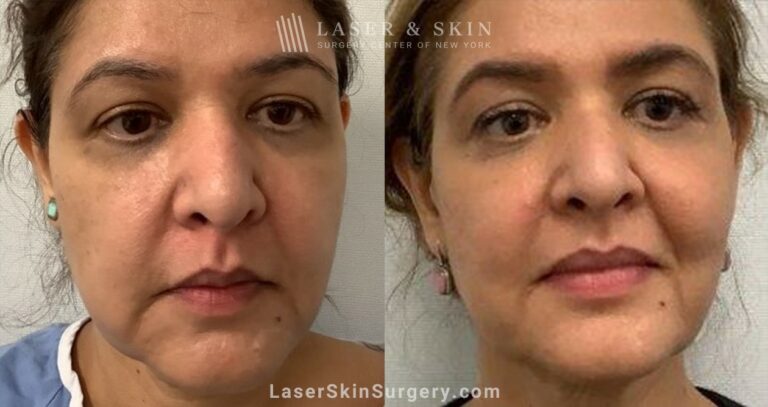 8 months post ultherapy and sofwave lifting lower face and replacing lost mid cheek volume