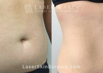 CoolSculpting Treatments to Sculpt the Abdomen