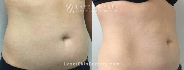 CoolSculpting Treatments to Sculpt the Abdomen