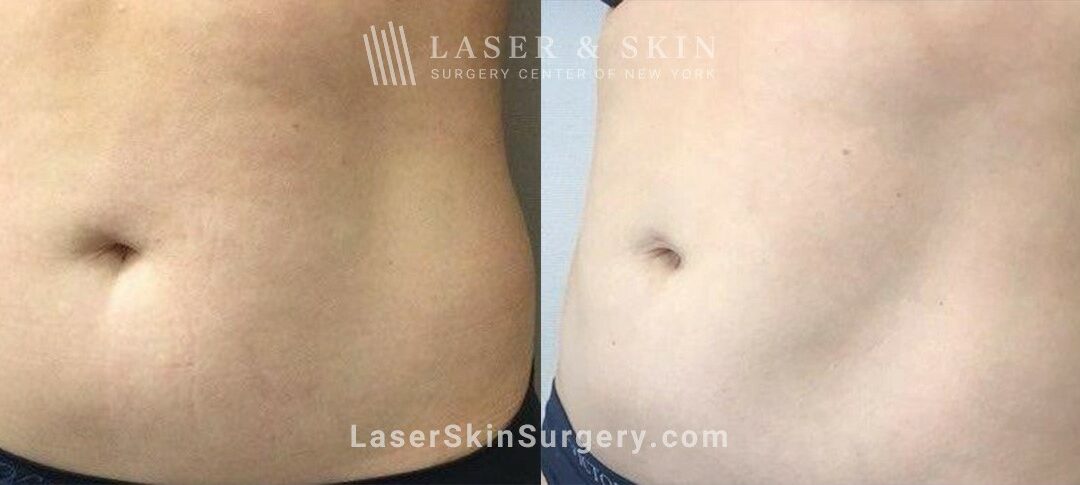 CoolSculpting Treatments to Sculpt the Abdomen