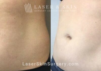 CoolSculpting Treatments to Sculpt the Abdomen