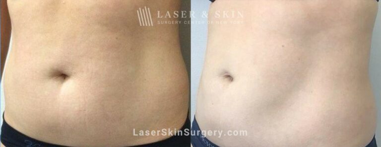 CoolSculpting Treatments to Sculpt the Abdomen