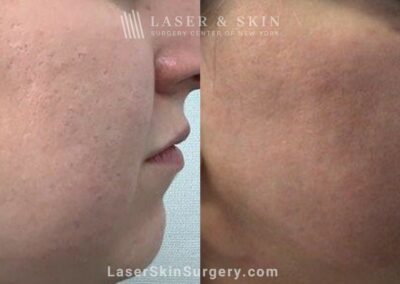 10 Days Fractional Carbon dioxide with Topical Sculptra Application