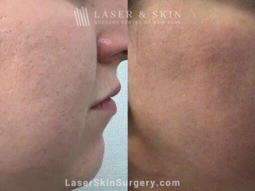 10 Days Fractional Carbon dioxide with Topical Sculptra Application