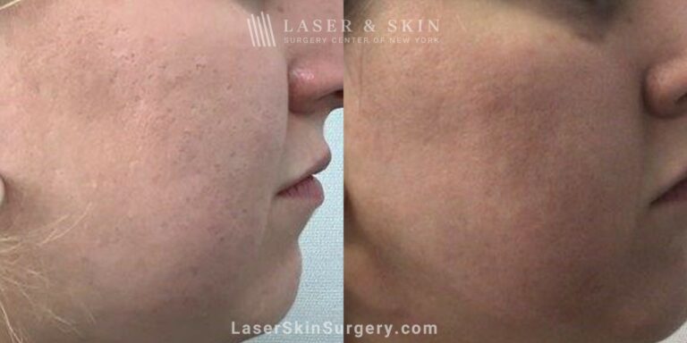 10 Days Fractional Carbon dioxide with Topical Sculptra Application