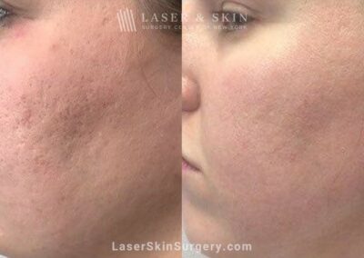 10 Days Fractional Carbon dioxide with Topical Sculptra Application