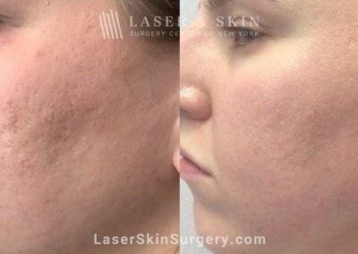4 Microneedling Sessions, CO2 Laser Resurfacing, and Sculptra for Acne Scarring and Smoother Skin