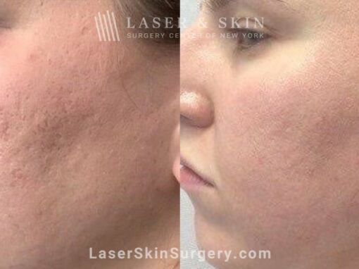 4 Microneedling Sessions, CO2 Laser Resurfacing, and Sculptra for Acne Scarring and Smoother Skin