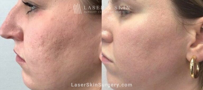 4 Microneedling Sessions, CO2 Laser Resurfacing, and Sculptra for Acne Scarring and Smoother Skin