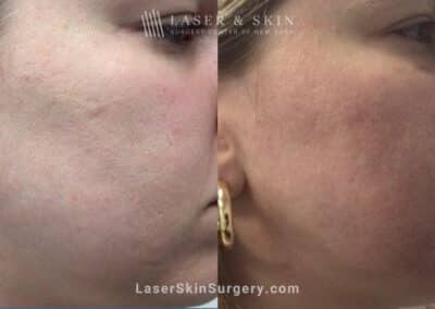 4 Microneedling Sessions, CO2 Laser Resurfacing, and Sculptra for Acne Scarring and Smoother Skin